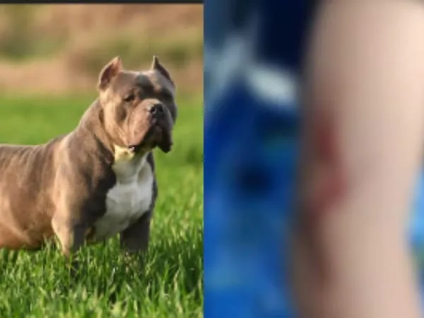 Ataque de perro American Bully en Palmira dejó a niño con graves heridas faciales