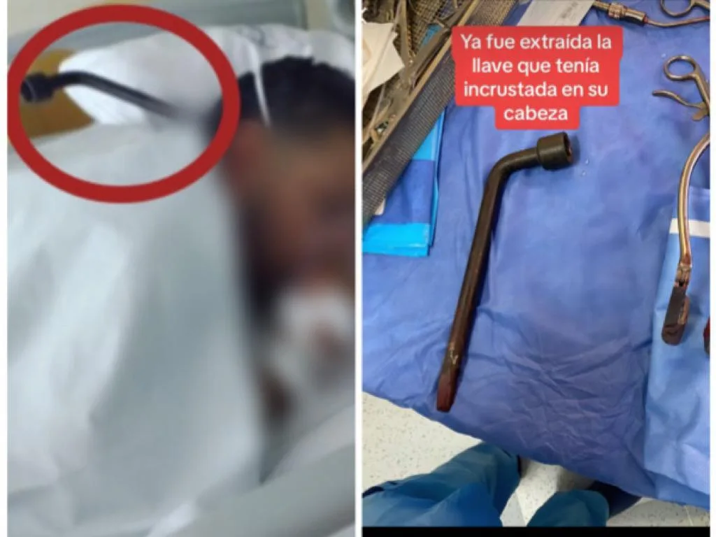 Ya le extrajeron la cruceta de la cabeza y sobrevivió: caso de taxista herido en pelea en Medellín