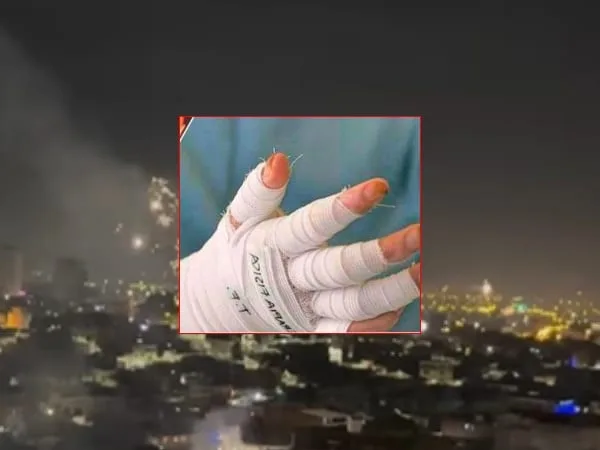Secretaría de Salud de Cali reportó nueva cifra de quemados por pólvora tras Nochebuena; el aumento es preocupante