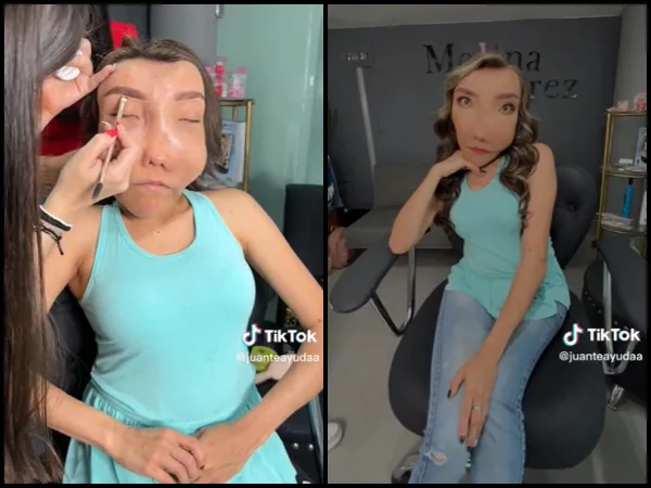 "La belleza no es solamente lo físico": la historia de Leidy Ardila y la displacía fibrosa que "me muestra la vida de otra manera"
