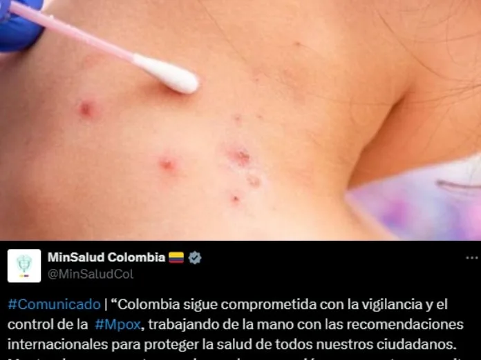 "No se descarta tener vacunas": MinSalud frente a los 109 casos de viruela símica en Colombia