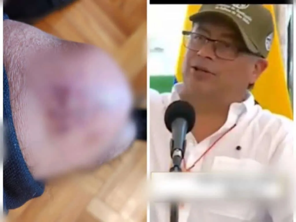 "Tuve una caída en Cartagena", Petro responde que estaba de reposo