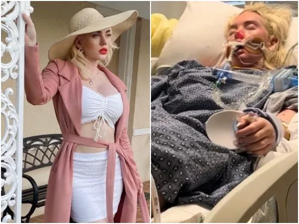 Famosa modelo de Georgia le amputaron una pierna tras contraer la bacteria «come carne»