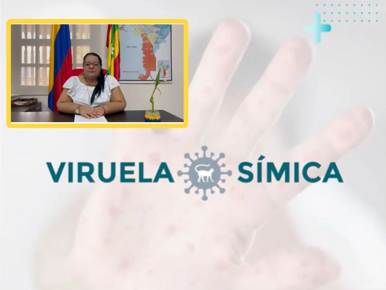 viruela símica Cartagena