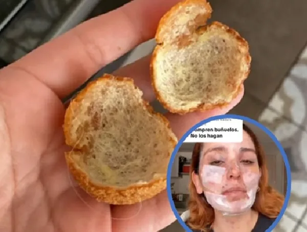Joven que se quemó haciendo buñuelos.
