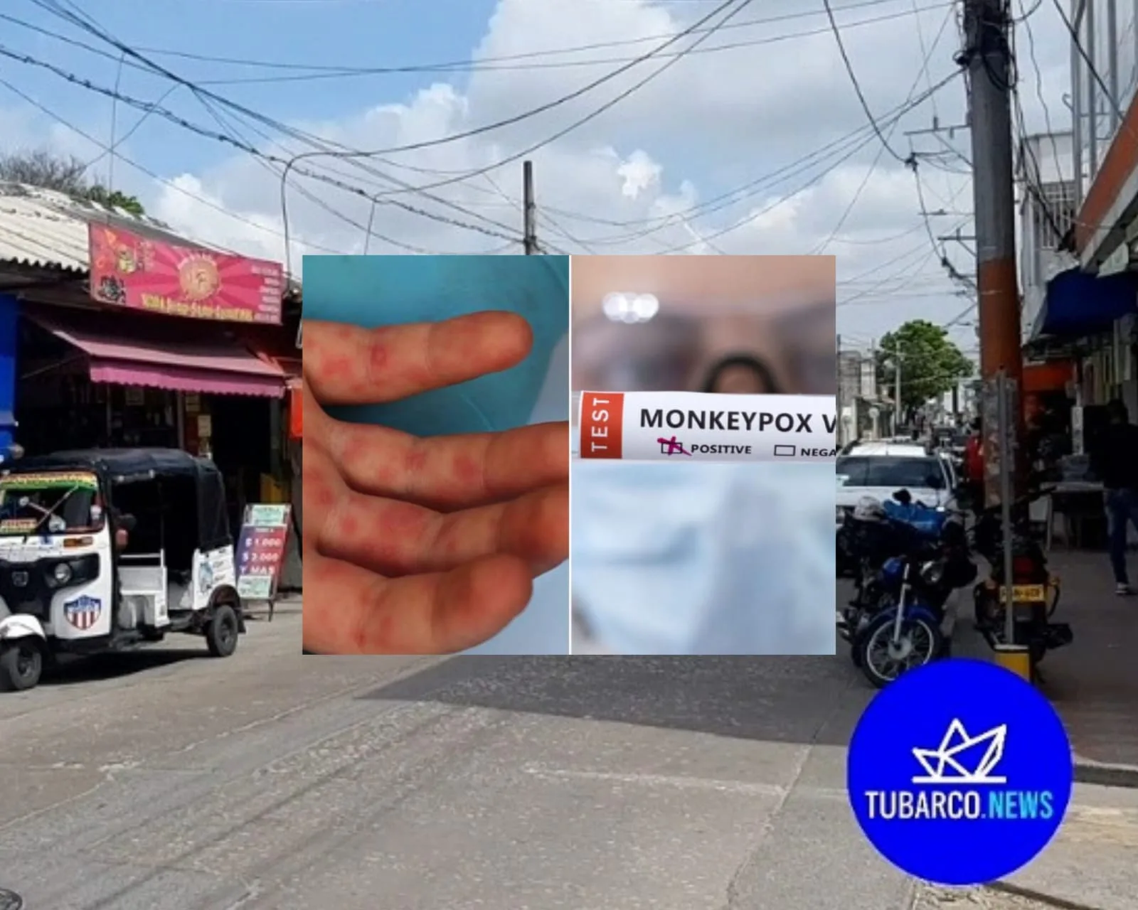 La viruela del mono también "se trepó" en el Atlántico, confirmaron primer caso en un municipio de la región