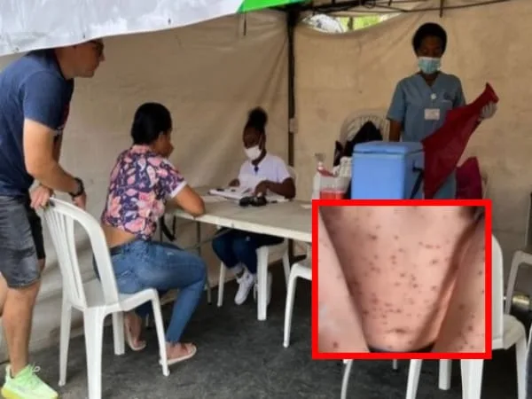 Ya son dos los casos de viruela símica en Cali: ninguno de los pacientes está relacionado, Secretaría de Salud
