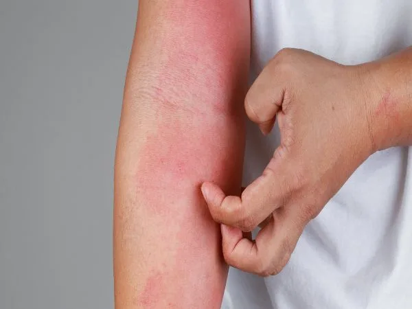 «Día Mundial de la Dermatitis Atópica»: El 50% de casos inician en el primer año de vida