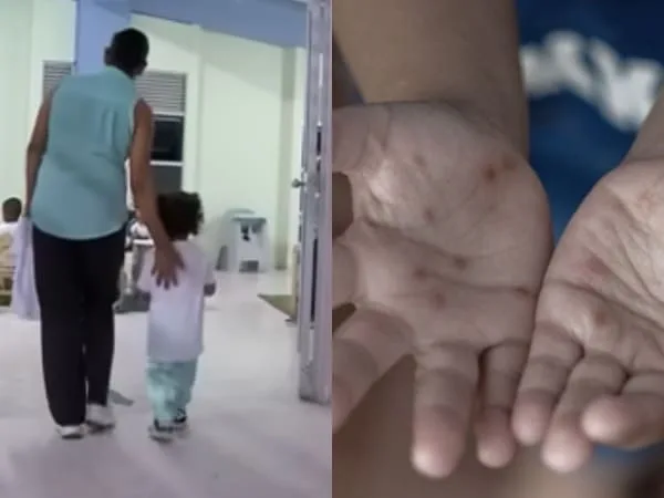 Se mantienen activas las medidas de vigilancia epidemiológica frente al síndrome de manos, pies y boca. Desde la Secretaría de Salud mecionaron las medidas de bioseguridad para padres de familia y cuidadores pues esta afectando directamente a menores