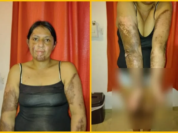 Yenni joven quemada en Pasto Chachagüí