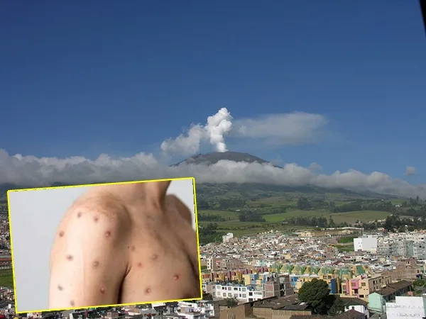 Pasto confirmó el segundo caso de viruela símica y el tercero para Nariño