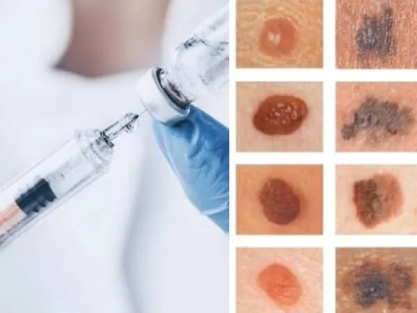Inician las primeras pruebas de la vacuna de ARNm contra el melanoma, un tipo de cáncer de piel