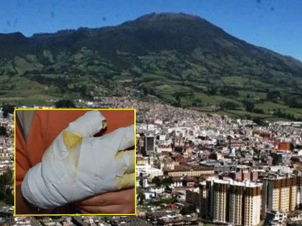 En Pasto a un menor de 12 años le tuvieron que amputar los dedos por manipulación de pólvora